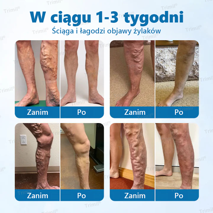 Trimil® Ziołowy Spray na Ochronę Żył - ✨Klinicznie udowodniono, że eliminuje żylaki w zaledwie 7 dni!